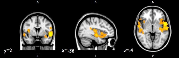 teen brain: Cross-section of 3 brain scans